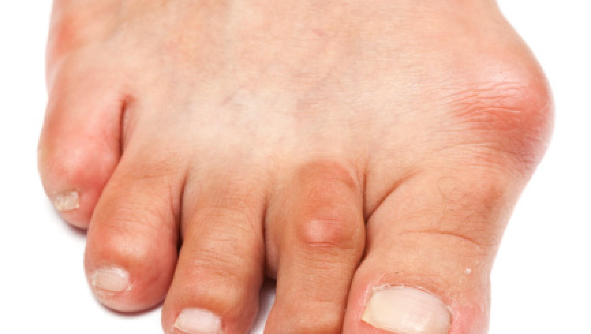 Bunion